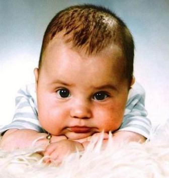 Уход за ребенком после удаления родинки