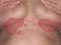 Псориаз сгибательных поверхностей, который проявляется в складках кожи