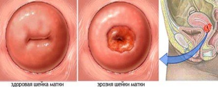 В большинстве случаев болезнь имеет длительный бессимптомный период и не вызывает никакого дискомфорта