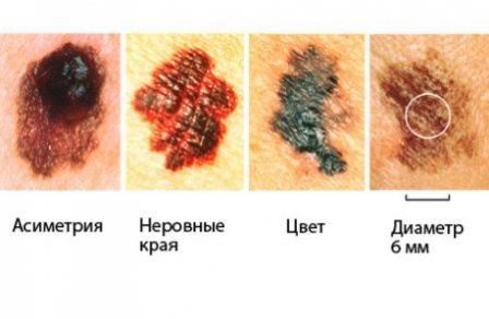 По этим признакам можно заподозрить развитие меланомы