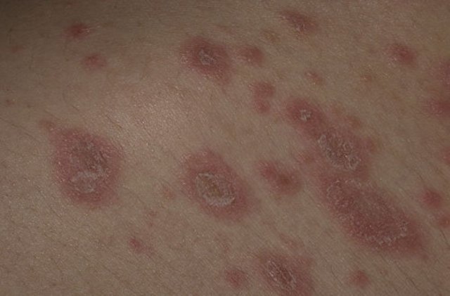Категорически запрещено мыть пораженные участки в горячей воде, распаривать кожу. Желательно вообще не мочить пораженные участки