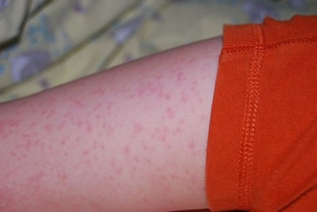 При возникновении аллергической реакции под воздействием продуктов питания, лекарств и других факторов на коже могут появиться сильный зуд и мелкие ярко-розовые волдыри разного размета