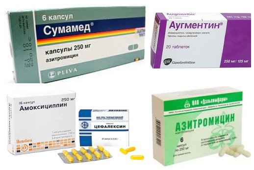 Антибактериальные препараты широкого спектра действия в лечении заболеваний вызванных стрептококком Антибиотики при стрептококковой инфекции в горле