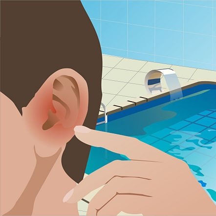 Попадание в уши воды - частая причина отомикоза.