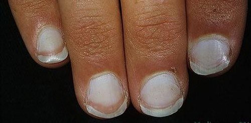 Тотальное повреждение ногтевой пластины
