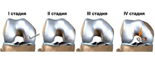 Рассекающий остеохондроз 
