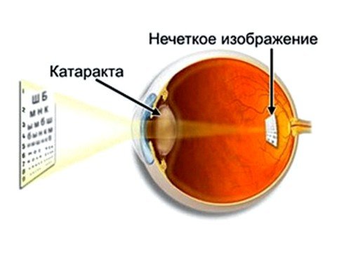 Причины катаракты