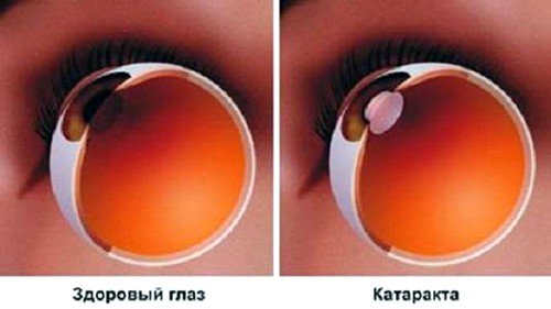 Здоровый глаз и катаракта