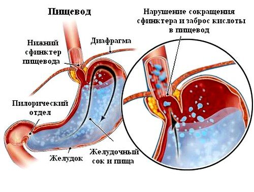 дуодено гастральный рефлюкс может оказаться синдромом, сопровождающим отдельные заболевания желудочно-кишечного тракта