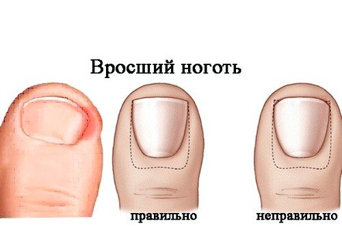 Причины возникновения вросшего ногтя
