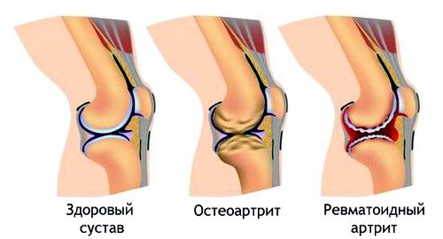 ревматоидный артрит как причина боли в колене
