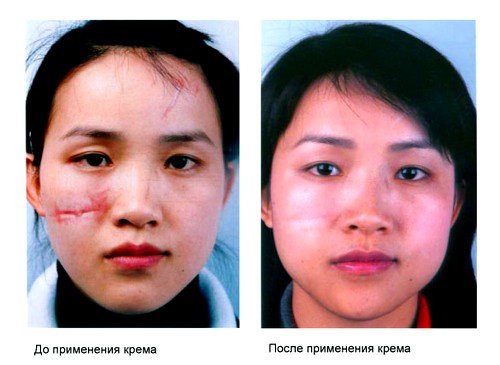 Отзывы после применения Келофибразе