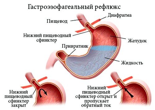 Гастроэзофагеальнаярефлюксная болезнь