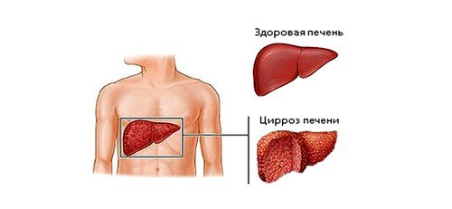 Цирроз печени: последняя стадия