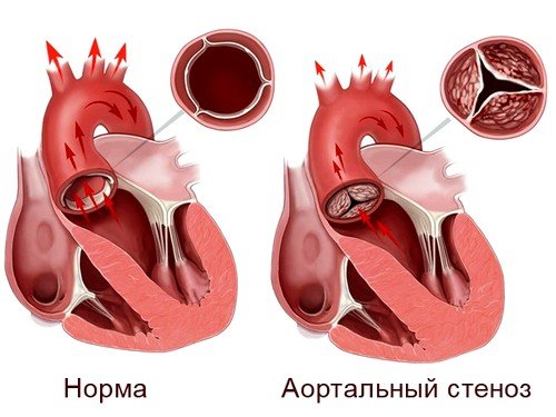 Аортальный порок сердца Аортальный порок сердца