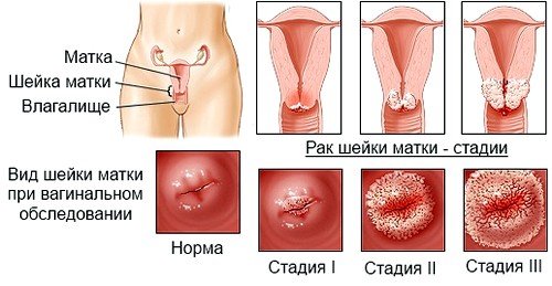 Стадии развития рака матки