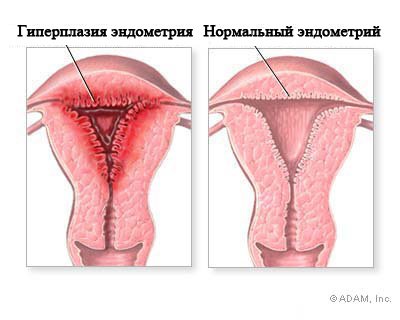 гипоплазия эндометрия