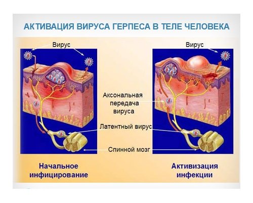 Вирус Varicella-zoster остается в спинномозговых корешках и ганглиях на протяжении всей жизни человека