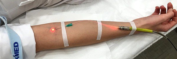 Лазерное облучение крови - один из новых методов лечения аллергии Лазерное облучение крови - один из новых методов лечения аллергии