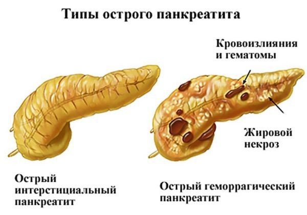 Типы острого панкреатита