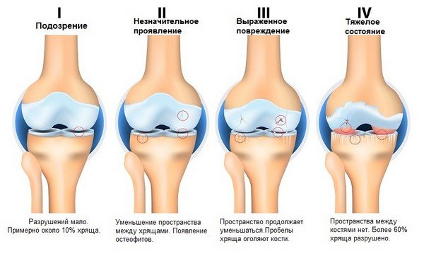 Развитие артроза коленного суства