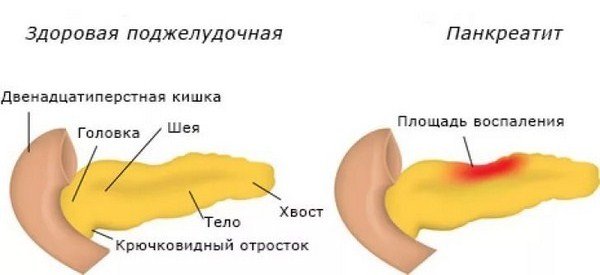 Хронический панкреатит