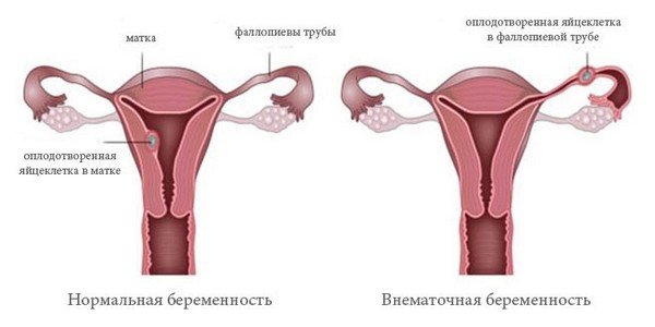 Нормальная и внематочная беременность, рисунок