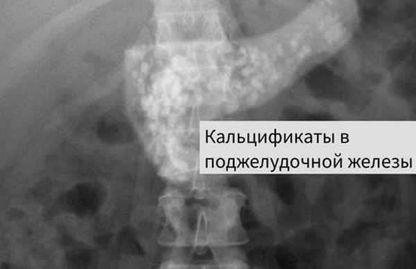 Кальцифицирующий панкреатит
