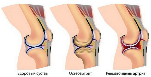 Здоровый коленный сустав и ревматоидный артрит Здоровое колено и артрит