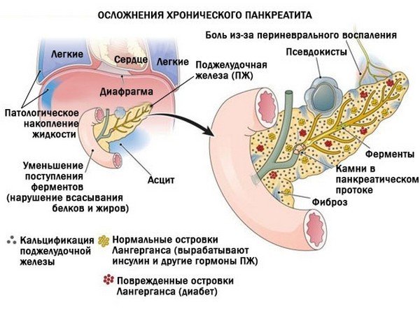 Осложнения панкреатита схема