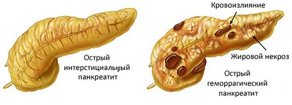 Типы острого панкреатита Типы острого панкреатита на схеме