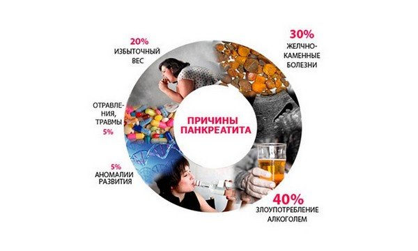 Причины панкреатита, диаграмма