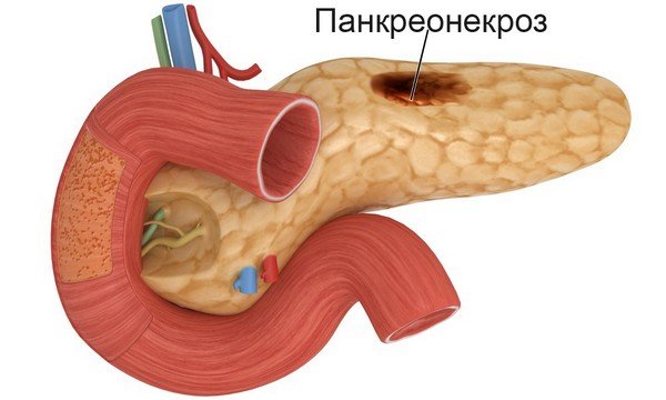 Панкреонекроз