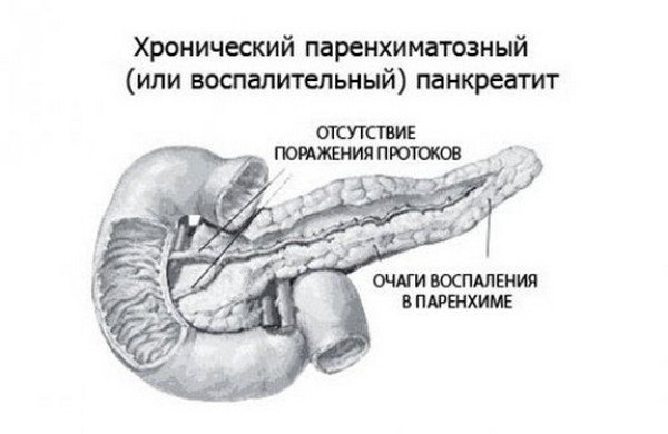 Паренхиматозный панкреатит