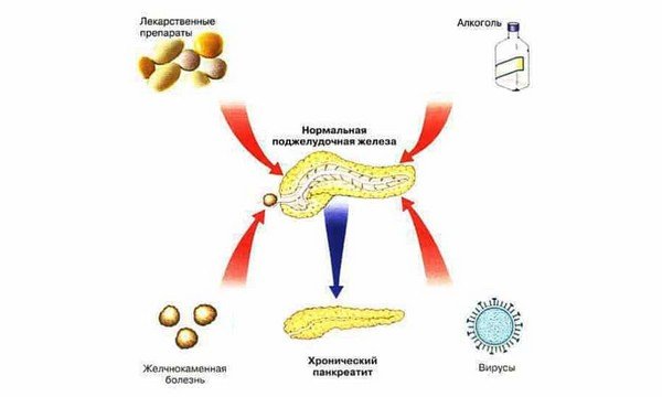 Причины панкреатита схема