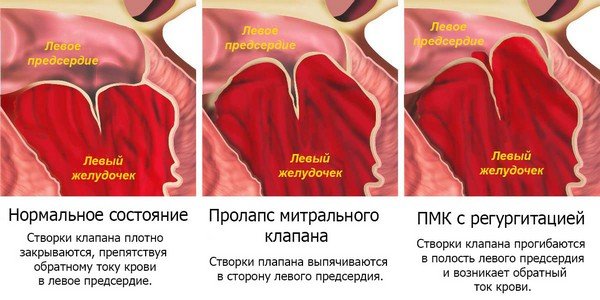Пролапс митрального клапана