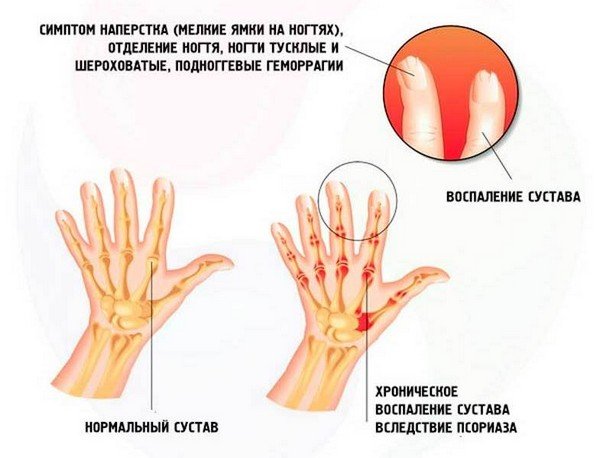 Симптомы псориатического артрита фото