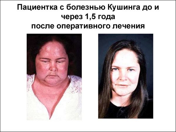 Синдром Иценко Кушинга: фото до и после