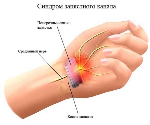 Тоннельный синдром