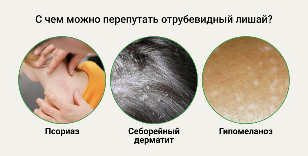 Отрубевидный лишай
